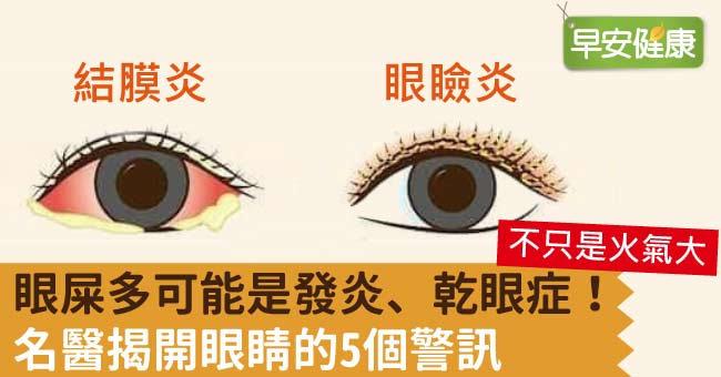 眼屎多可能是發炎、乾眼症！名醫揭開眼睛的5個警訊