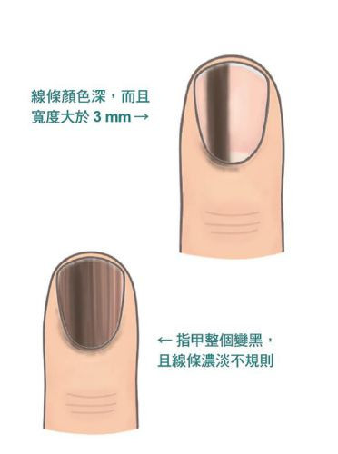 惡性黑甲症