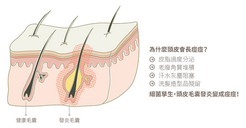 頭皮毛囊炎讓頭皮長痘痘