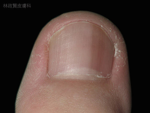 指甲帶狀色素，檢查黑色素瘤、皮膚癌