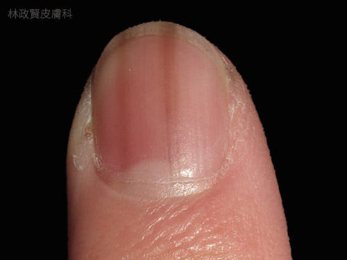 指甲有條紋是皮膚癌嗎？