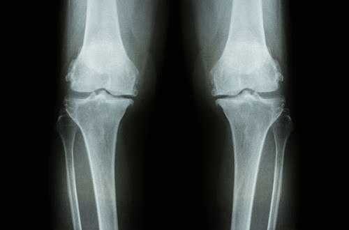 膝蓋退化性關節炎的最大特色，就是骨頭之間的軟骨流失
