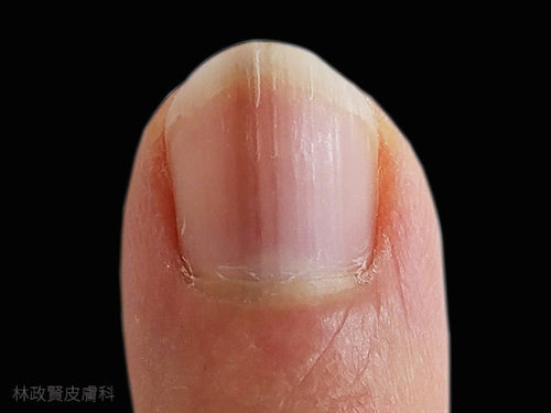 指甲有條紋是黑色素瘤、皮膚癌嗎？