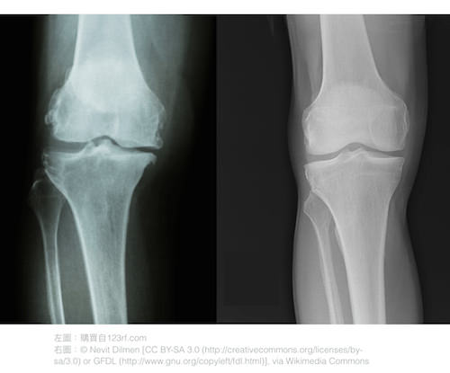 正常的膝關節與軟骨後度降低的膝關節。