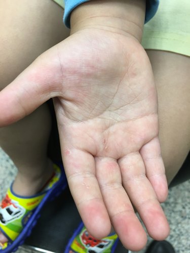腸病毒約兩周後孩子的指甲可能會脫落