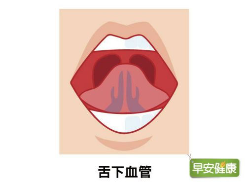 舌下靜脈呈暗紫色凸起是血瘀徵兆，應注意心血管健康。