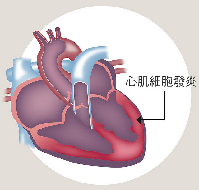 心臟因素引起的胸痛：心肌炎