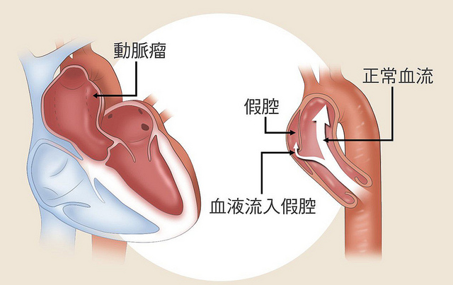 心臟因素引起的胸痛：主動脈剝離