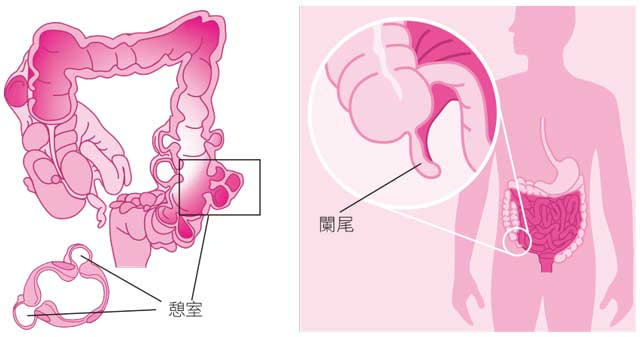 盲腸炎、闌尾炎、大腸憩室炎