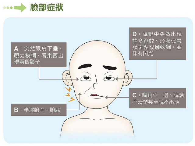 危急的臉部症狀包括突然視力模糊、眼皮下垂、嘴角歪斜、臉歪臉麻等。