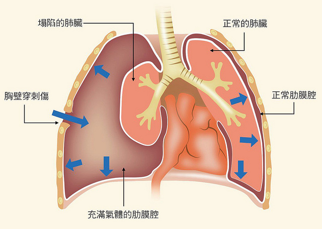 若氣胸嚴重，肋膜腔累積的氣體太多，會壓迫到腔靜脈而影響回心血流。