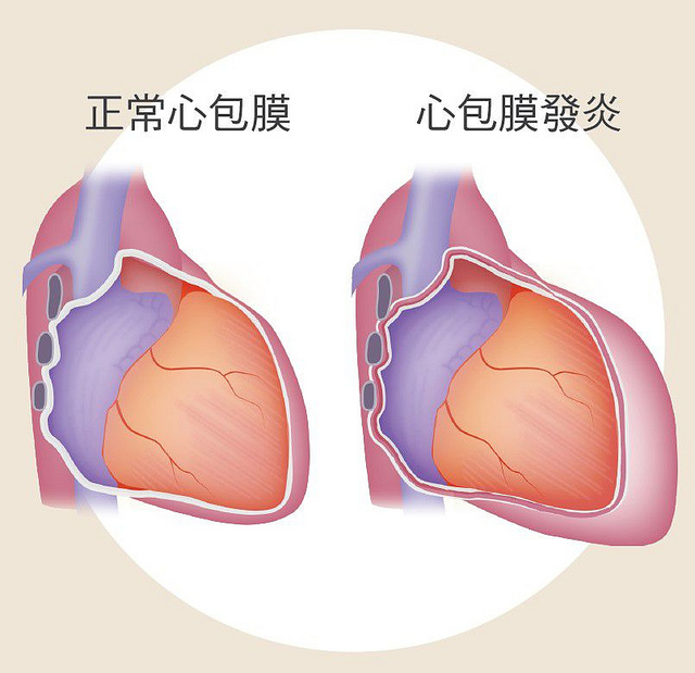心臟因素引起的胸痛：心包膜炎
