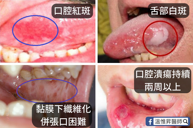 口腔白斑常發生在舌頭或頰黏膜(嘴皮)，是最常見的一種，而紅斑的癌變機率更高達6成