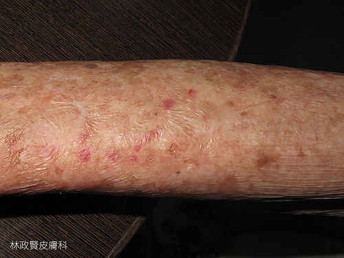 紫斑症：老年性、手臂外側、症狀較輕微
