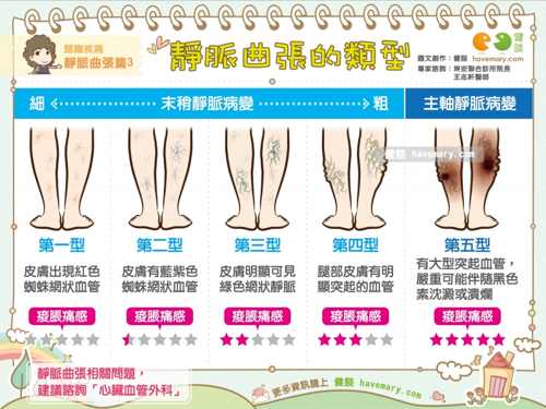 靜脈屈張