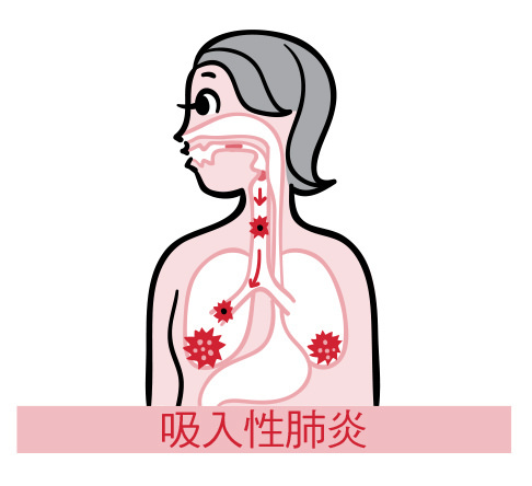 吞嚥力衰退可能使異物進入氣管，造成吸入性肺炎