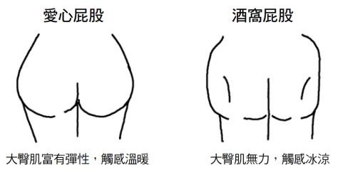陰道和會陰變寒、僵硬，會造成骨盆底肌肉衰退，進而影響屁股的形狀。