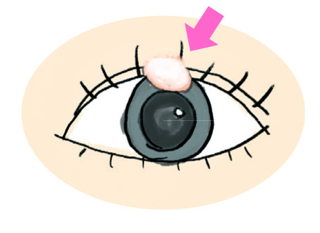針眼症狀：眼瞼內外長出白色圓形顆粒