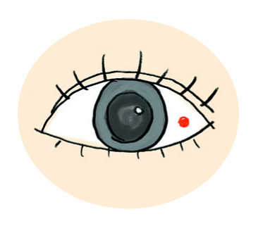結膜下出血症狀：白眼球出現紅色斑點