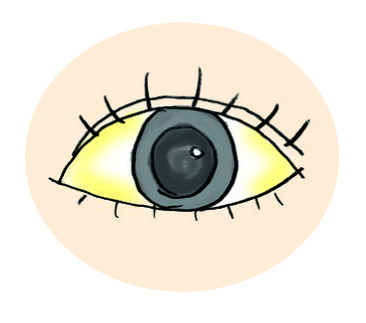 肝病（黃疸）症狀：白眼球變成黃色