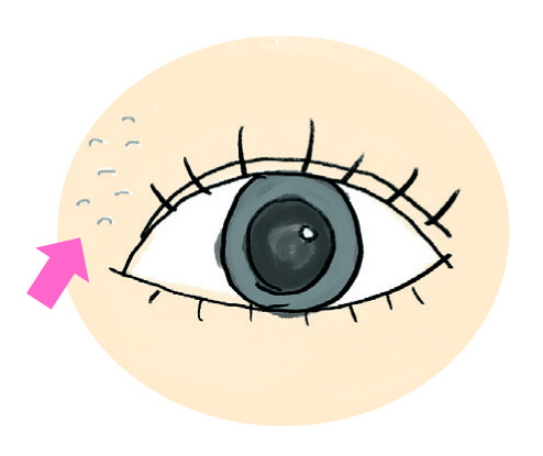 汗管瘤症狀：眼瞼表面長出膚色、小小平平的顆粒。