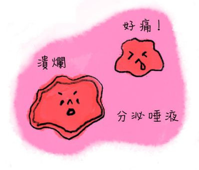 皰疹性口內炎症狀：米粒般大小的不規則破洞、紅色潰爛狀