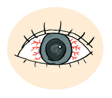 角膜炎症狀：黑眼球四周充血