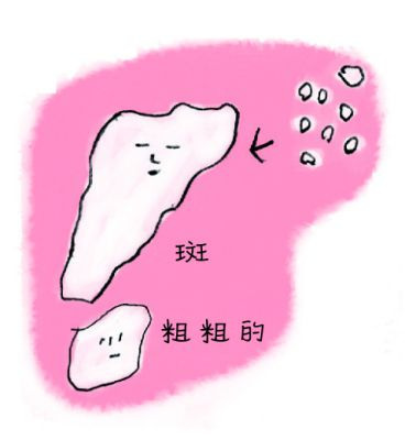 念珠菌性口內炎症狀：舌頭、口腔黏膜出現白色斑點，之後逐漸擴散、長出白色舌苔