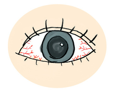 結膜炎症狀：扁求周邊和內眼瞼充血
