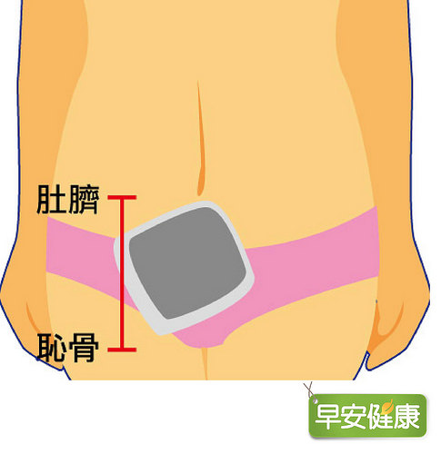 膀胱溫敷法