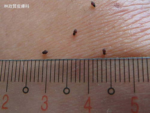 小黑蚊的體形只有約1至1.4mm。(照片由患者提供)