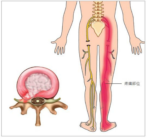 依據椎間盤突出的方向，可能引起腰痛或下肢疼痛。