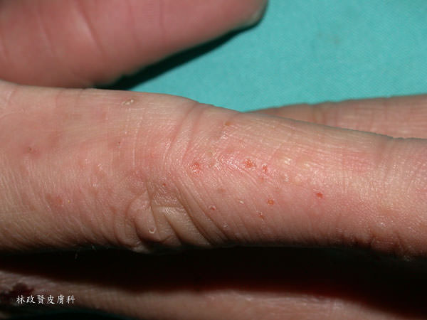 汗皰疹是一種好發於手、腳的反覆發作性濕疹性疾病