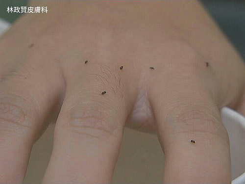 小黑蚊的體形比一般的蚊子小很多，在手背上看起來，只是一個個小黑點。(照片由患者提供)
