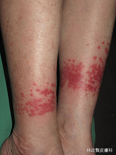 小黑蚊會叮咬沒有被長褲、襪子或鞋子覆蓋的皮膚