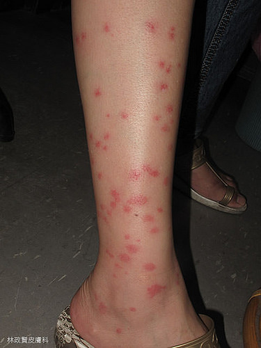 小黑蚊叮咬小腿症狀，有許多劇癢的紅色丘疹傷口