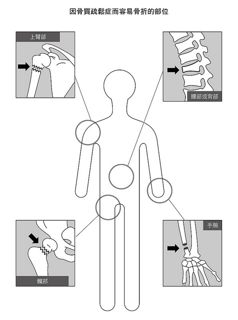 容易因為骨質疏鬆骨折的部位：上臂、腰背部、髖部、手腕