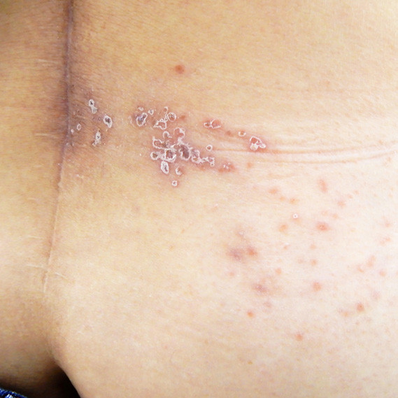 帶狀疱疹的帶狀分布，可見傷口部分已結痂