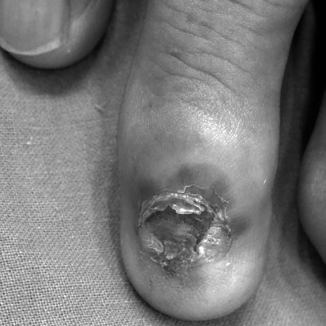 位於手指的肢端黑色素瘤