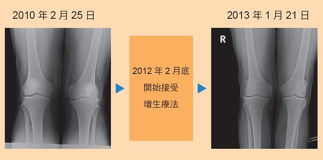 增生療法案例：嚴重型膝關節退化性關節炎
