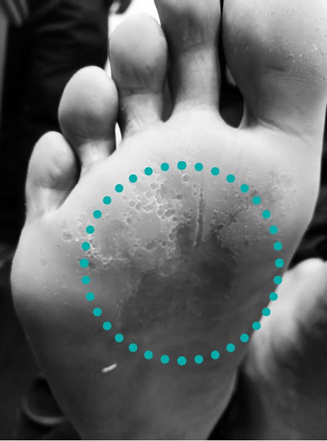 腳臭原因：足蹠蠹蟲症是細菌感染造成，會在腳掌上形成一個一個小凹洞，看起來很像火山口