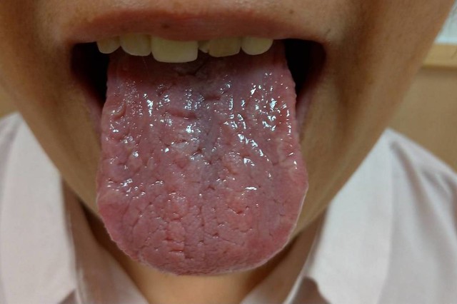 舌頭容易有裂紋可能代表腸胃狀況不好