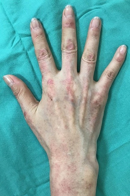 皮肌炎患者的手指關節處有紅疹及紅斑
