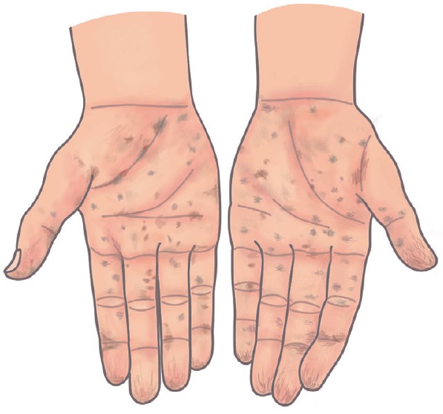 慢性砷中毒的皮膚會出現花花的黑白斑，手掌也會出現很多小凹洞，同時伴隨很多鱗狀上皮原位癌