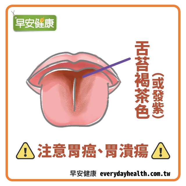 茶褐色的舌苔可能是胃潰瘍、胃癌等消化器官的警訊。