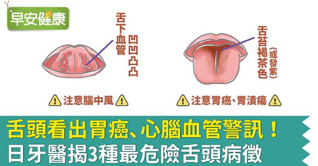 舌頭看出胃癌、心腦血管警訊！日牙醫揭3種最危險舌頭病徵