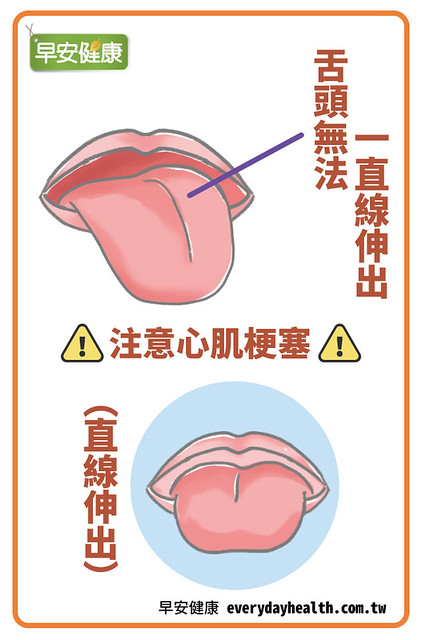 伸出舌頭時無法呈現一直線，可能是血管將堵塞、有心肌梗塞風險，或是控制舌頭肌肉的神經異常。