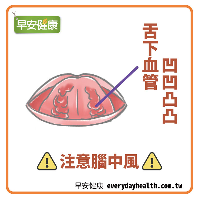 舌頭底下的血管異常扭曲，表示血液過於濃稠、循環異常，可能容易發生腦中風。