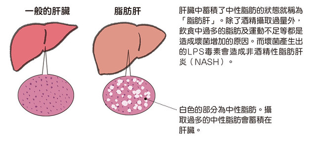 肝臟中蓄積了過多三酸甘油酯的狀態就稱為「脂肪肝」。