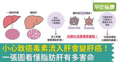 小心致癌毒素流入肝會變肝癌！一張圖看懂脂肪肝有多害命